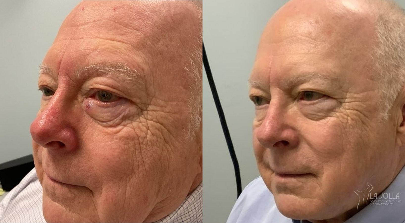 La Jolla Cosmetic Laser Clinic & Dermatology laser treatment result — San Diego, CA