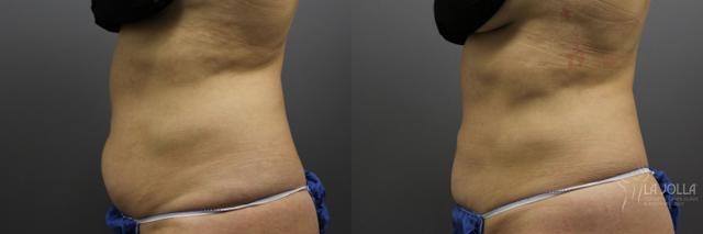 Thigh Lift result at La Jolla Cosmetic Laser Clinic & Dermatology in San Diego, CA