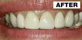 Point Loma Comprehensive Dental smile makeover after — San Diego, CA