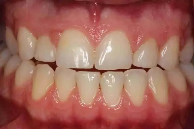 Smile Makeover after at Point Loma Comprehensive Dental in San Diego, CA