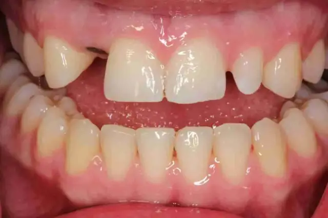 Smile Makeover before at Point Loma Comprehensive Dental in San Diego, CA