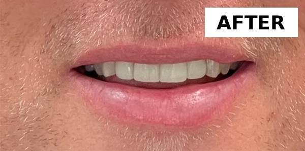 Point Loma Comprehensive Dental smile makeover after — San Diego, CA