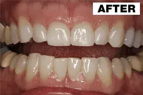 Smile Makeover after at Point Loma Comprehensive Dental in San Diego, CA