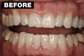 Smile Makeover before at Point Loma Comprehensive Dental in San Diego, CA