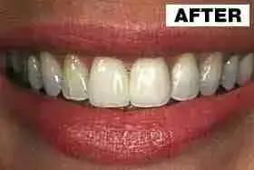 Point Loma Comprehensive Dental smile makeover after — San Diego, CA