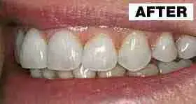 Point Loma Comprehensive Dental smile makeover after — San Diego, CA