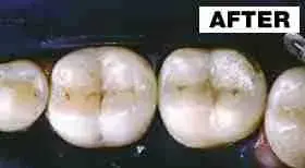 Point Loma Comprehensive Dental smile makeover after — San Diego, CA