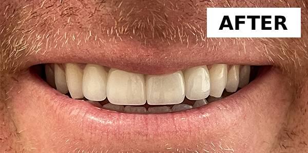 Point Loma Comprehensive Dental smile makeover after — San Diego, CA