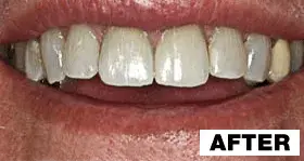 Point Loma Comprehensive Dental dental crowns after — San Diego, CA