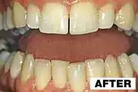 Point Loma Comprehensive Dental smile makeover after — San Diego, CA