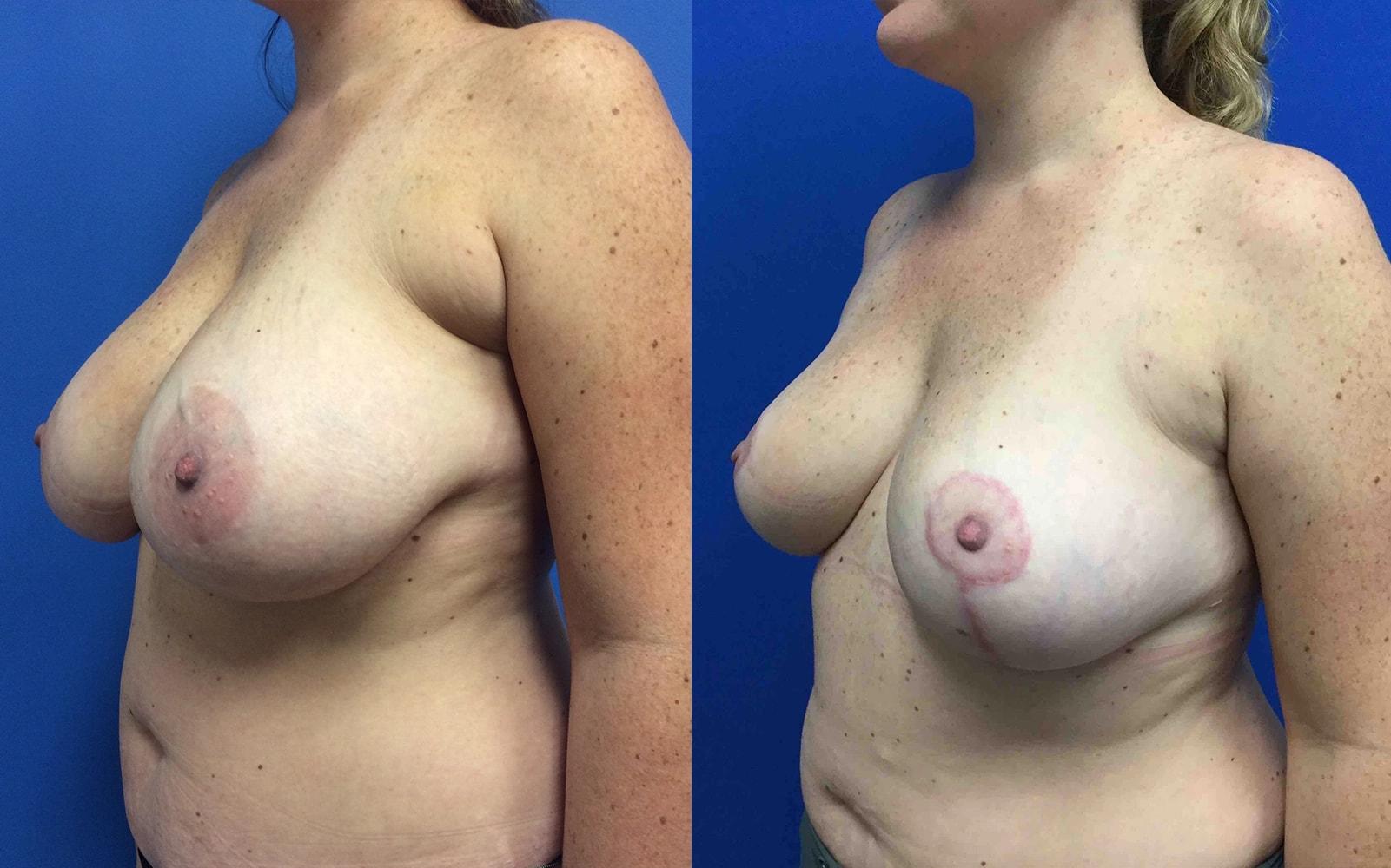 The Institute of Aesthetic Surgery breast reduction result — Winter Park, FL