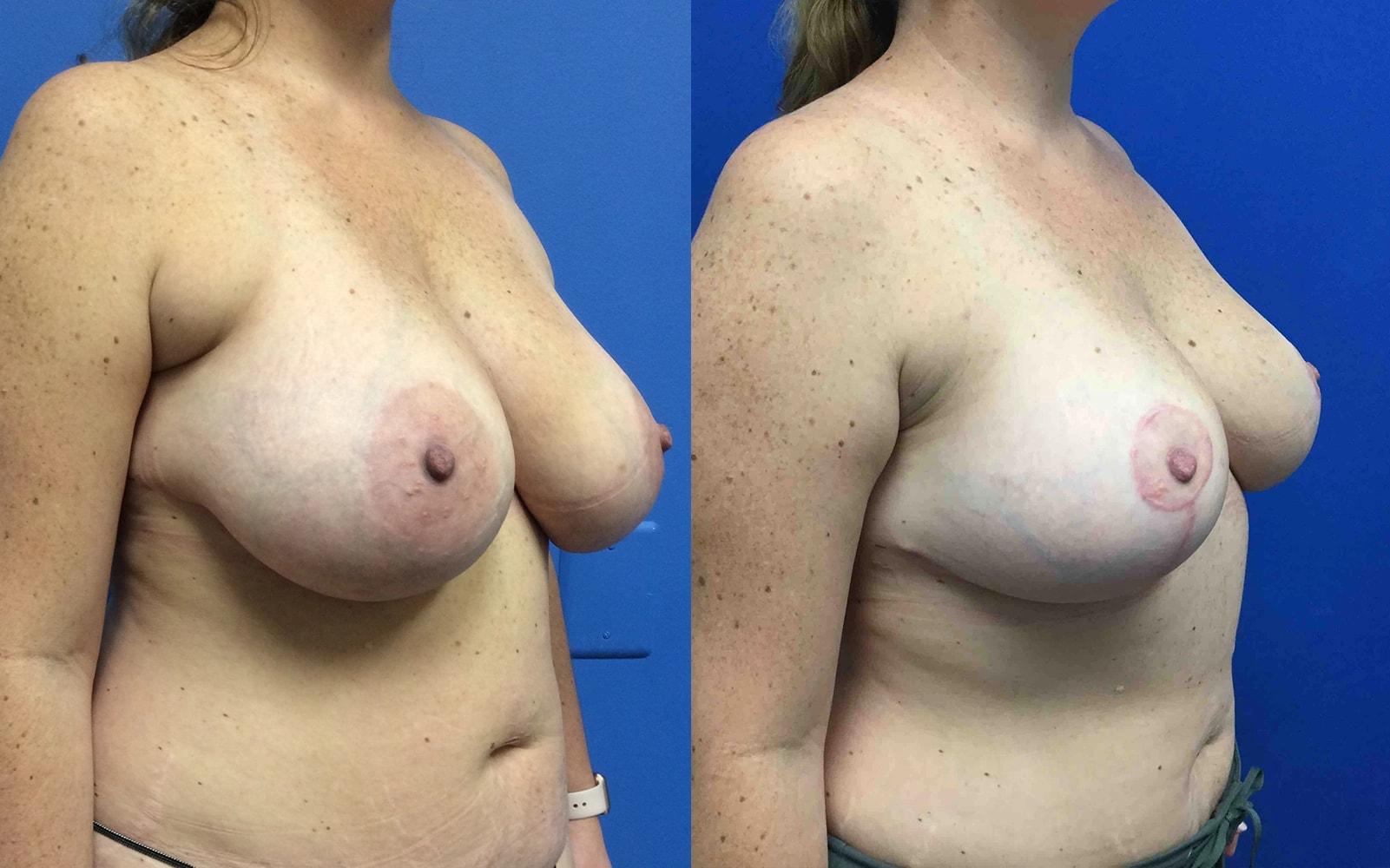 The Institute of Aesthetic Surgery breast reduction result — Winter Park, FL