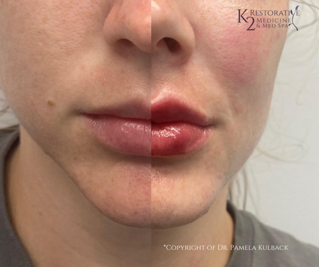 Lip Filler result at K2 Restorative Medicine & Med-Spa in Birmingham, AL