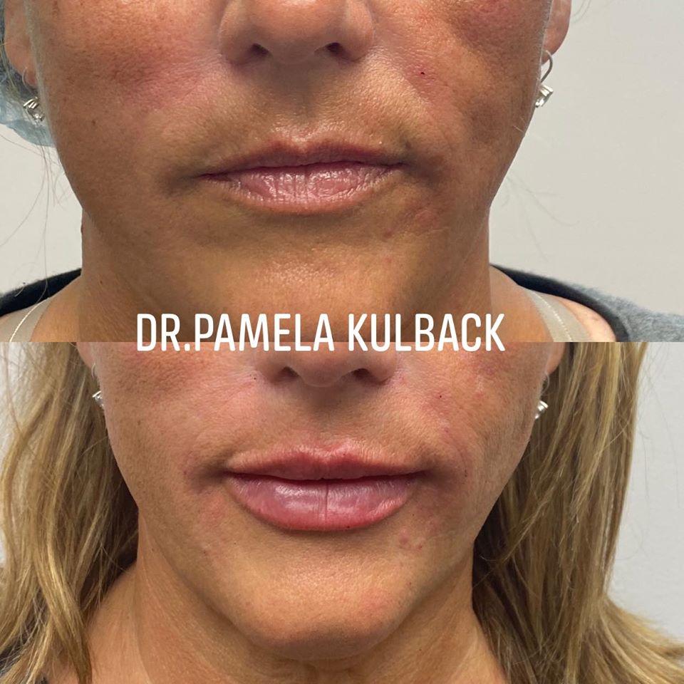 K2 Restorative Medicine & Med-Spa lip filler result — Birmingham, AL