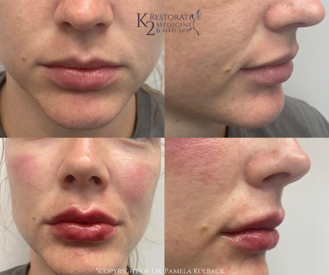 Lip Filler result at K2 Restorative Medicine & Med-Spa in Birmingham, AL