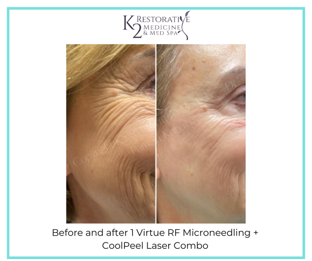 Microneedling result at K2 Restorative Medicine & Med-Spa in Birmingham, AL