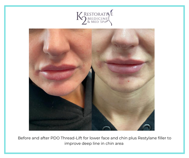 Jawline Filler result at K2 Restorative Medicine & Med-Spa in Trussville, AL