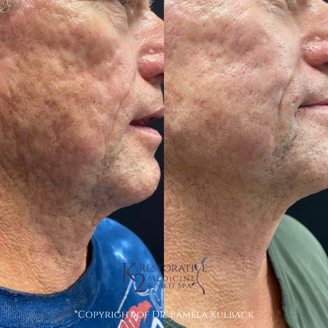 Microneedling result at K2 Restorative Medicine & Med-Spa in Birmingham, AL