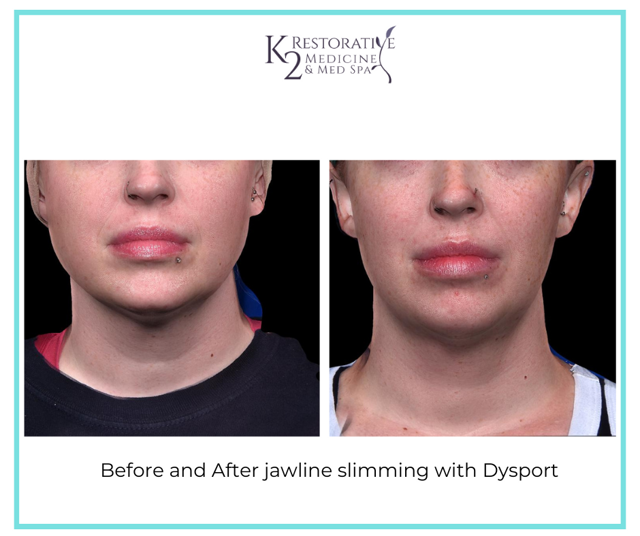 Botox result at K2 Restorative Medicine & Med-Spa in Birmingham, AL