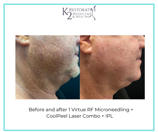 Microneedling result at K2 Restorative Medicine & Med-Spa in Birmingham, AL