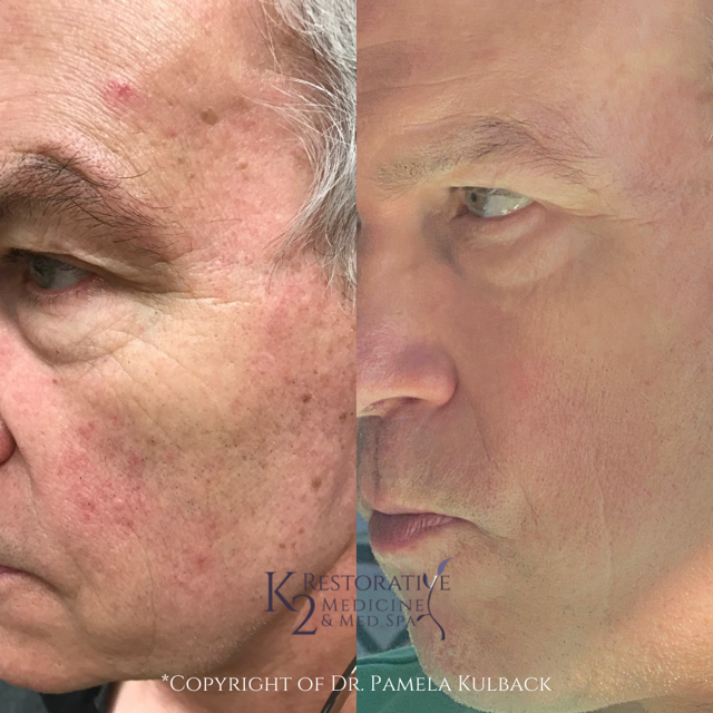 Laser Skin Resurfacing result at K2 Restorative Medicine & Med-Spa in Birmingham, AL