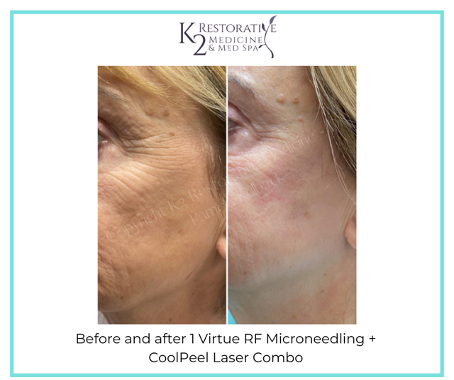 Microneedling result at K2 Restorative Medicine & Med-Spa in Birmingham, AL