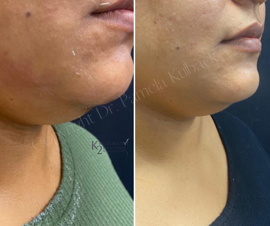 K2 Restorative Medicine & Med-Spa result — Birmingham, AL
