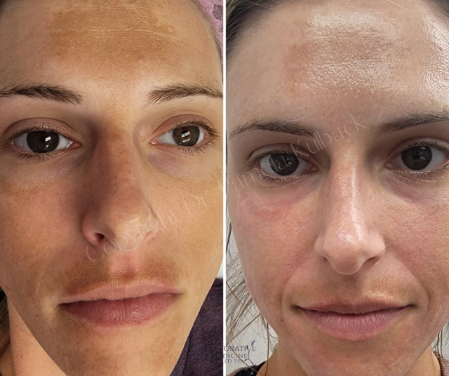 Chemical Peel result at K2 Restorative Medicine & Med-Spa in Birmingham, AL