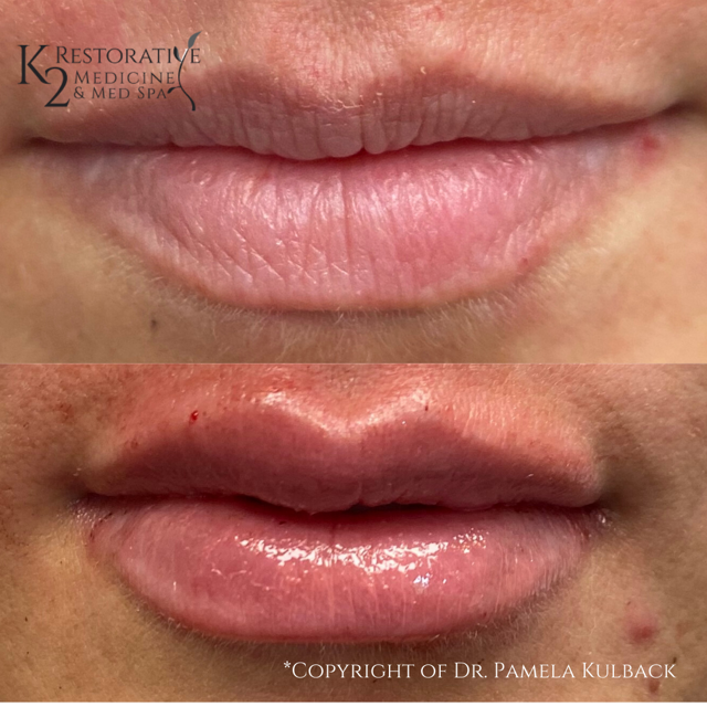 Lip Filler result at K2 Restorative Medicine & Med-Spa in Birmingham, AL
