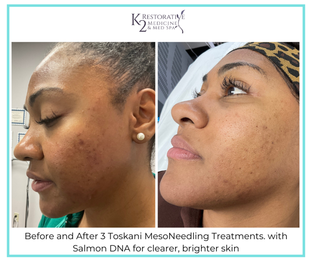 Microneedling result at K2 Restorative Medicine & Med-Spa in Trussville, AL