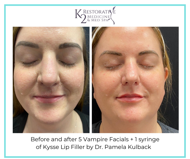 Lip Filler result at K2 Restorative Medicine & Med-Spa in Birmingham, AL