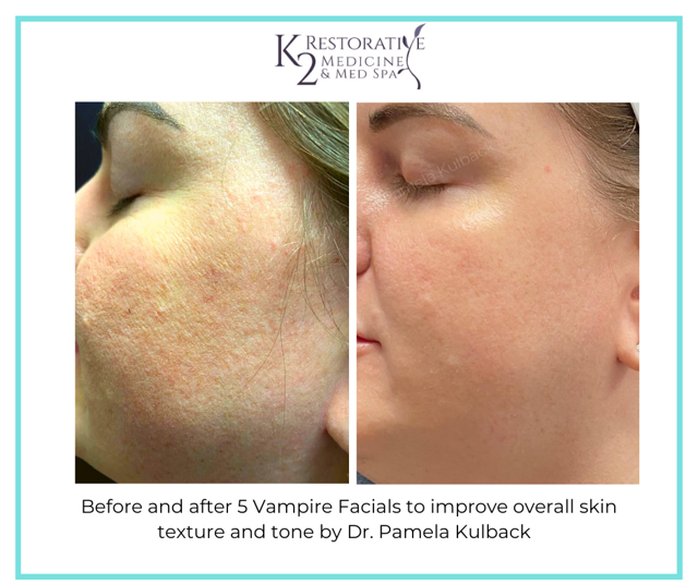 Chemical Peel result at K2 Restorative Medicine & Med-Spa in Trussville, AL