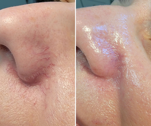 Laser Skin Resurfacing result at K2 Restorative Medicine & Med-Spa in Birmingham, AL