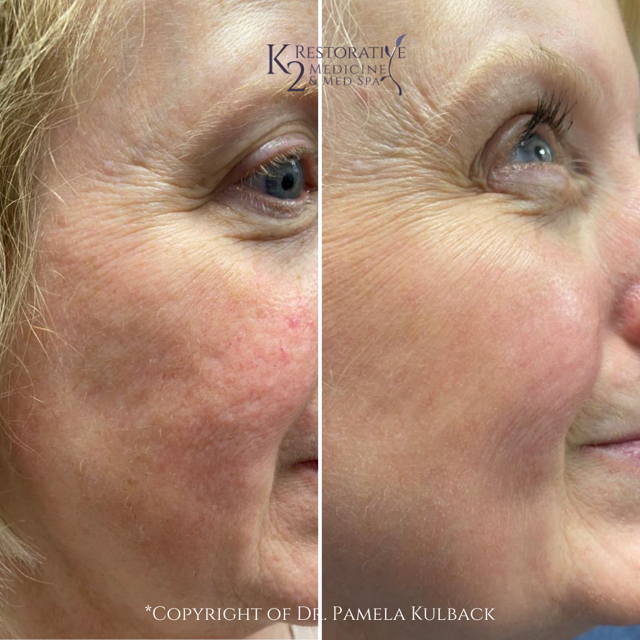 Laser Skin Resurfacing result at K2 Restorative Medicine & Med-Spa in Birmingham, AL