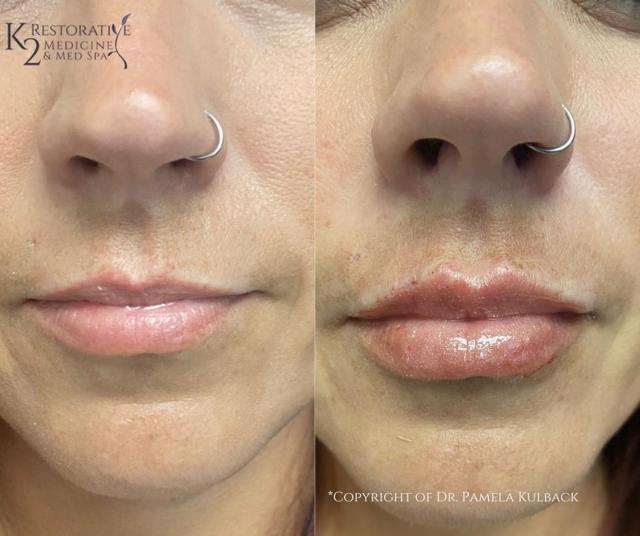 Lip Filler result at K2 Restorative Medicine & Med-Spa in Birmingham, AL