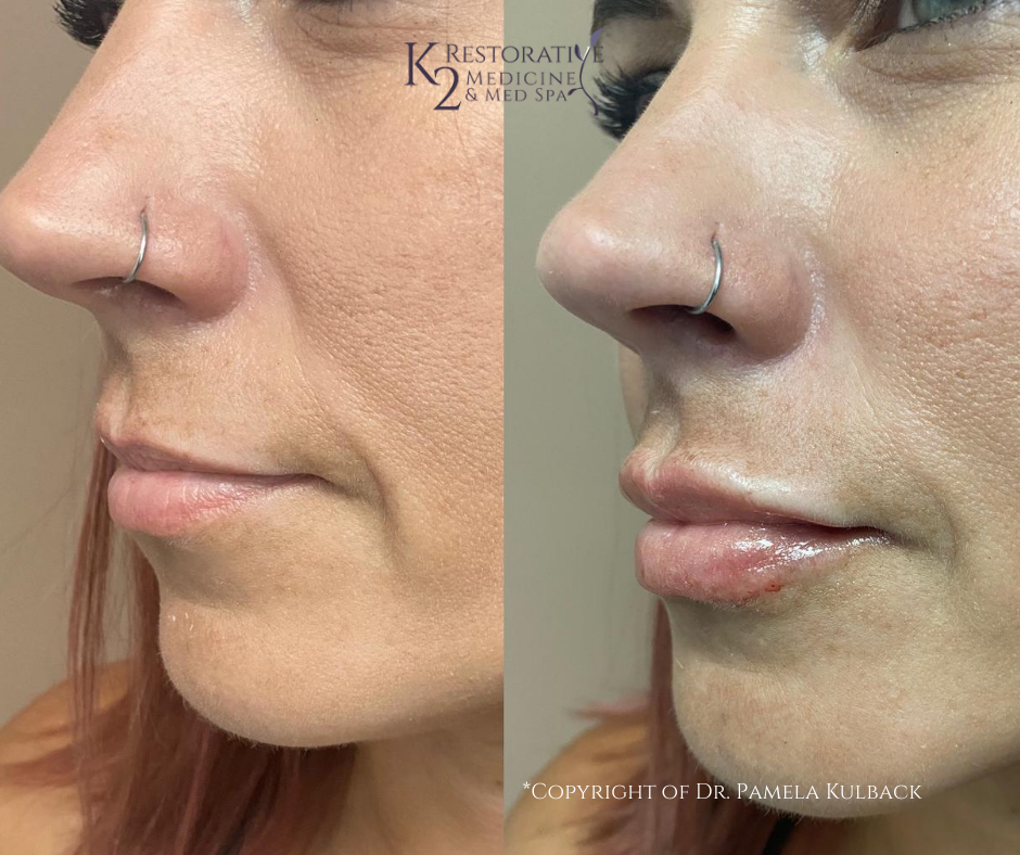 K2 Restorative Medicine & Med-Spa lip filler result — Birmingham, AL