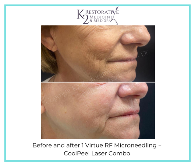 Microneedling result at K2 Restorative Medicine & Med-Spa in Birmingham, AL