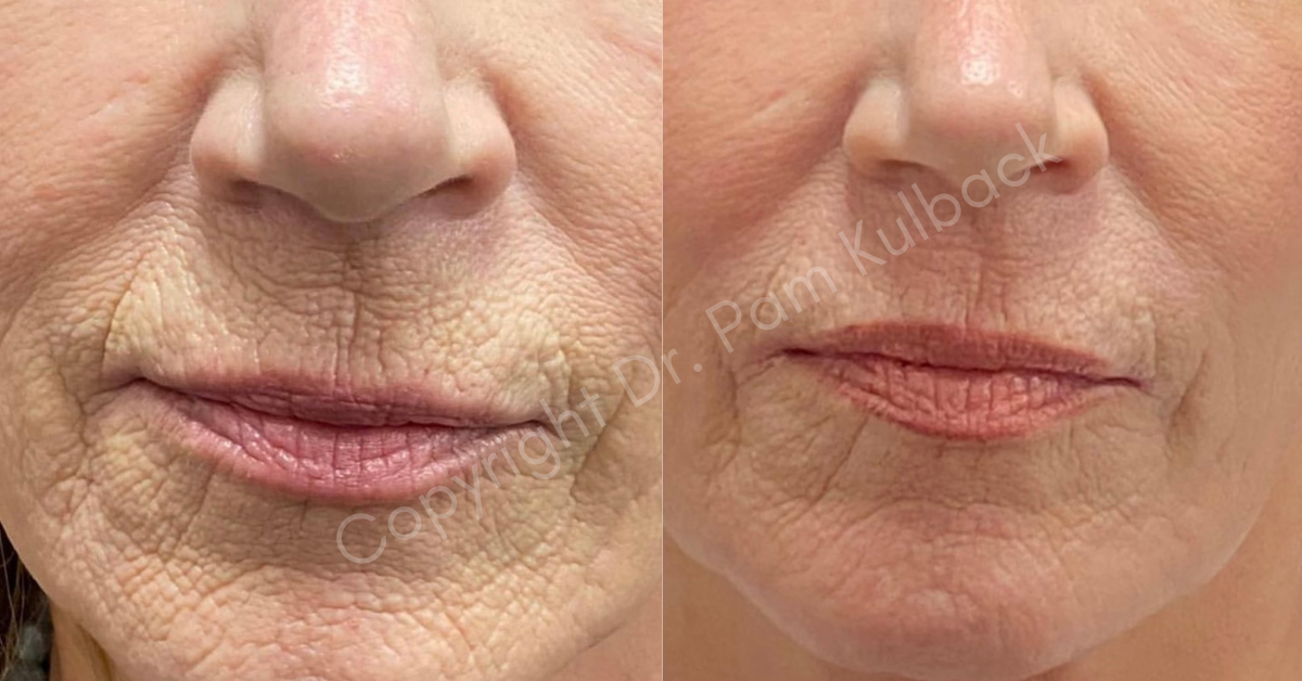 K2 Restorative Medicine & Med-Spa chemical peel result — Trussville, AL