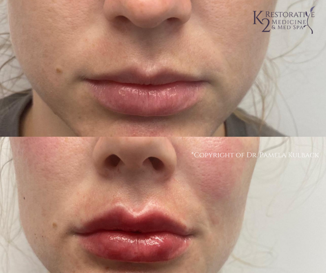 Lip Filler result at K2 Restorative Medicine & Med-Spa in Birmingham, AL