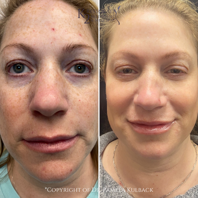 Laser Skin Resurfacing result at K2 Restorative Medicine & Med-Spa in Birmingham, AL
