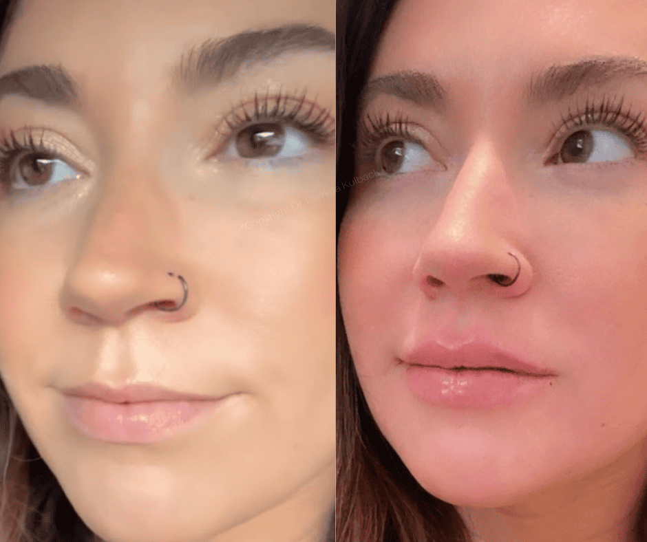 K2 Restorative Medicine & Med-Spa lip filler result — Birmingham, AL