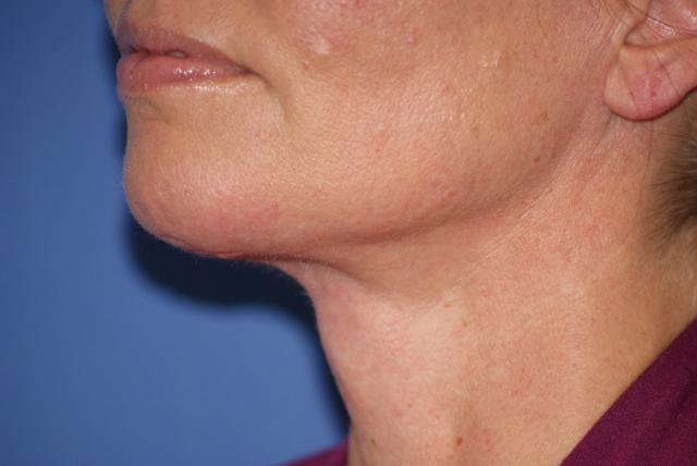 Neck Lift after at Chau Plastic Surgery in Berkley, MI