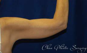 Arm Lift after at Chau Plastic Surgery in Berkley, MI