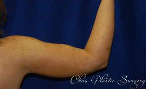 Chau Plastic Surgery liposuction after — Berkley, MI