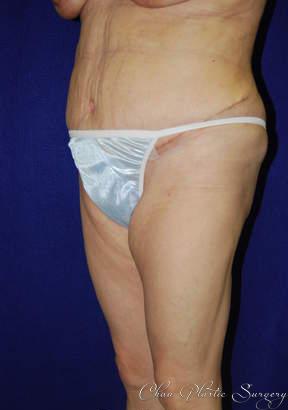 Chau Plastic Surgery tummy tuck after — Berkley, MI
