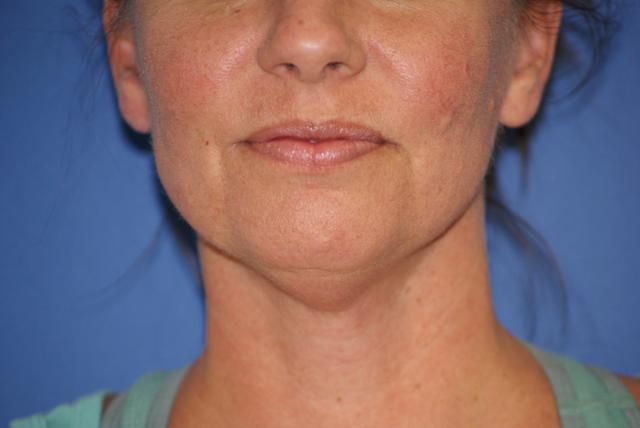 Neck Lift before at Chau Plastic Surgery in Berkley, MI