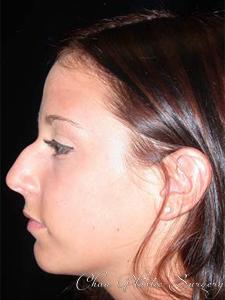 Rhinoplasty before at Chau Plastic Surgery in Berkley, MI