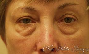 Blepharoplasty before at Chau Plastic Surgery in Berkley, MI