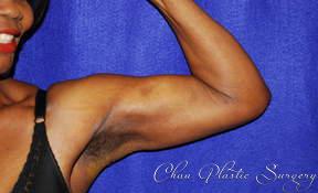Liposuction after at Chau Plastic Surgery in Berkley, MI