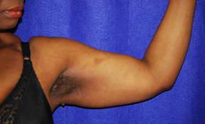 Liposuction before at Chau Plastic Surgery in Berkley, MI